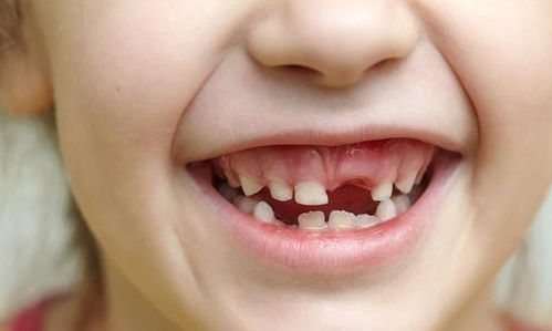 兒童換牙的注意事項(xiàng),兒童換牙期間注意事項(xiàng),6歲兒童換牙注意事項(xiàng)