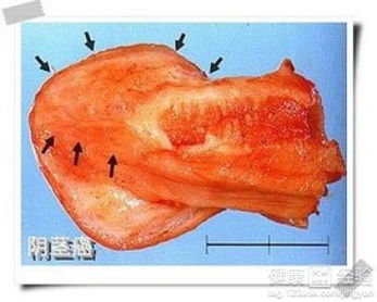 陰莖癌的飲食注意事項(xiàng)