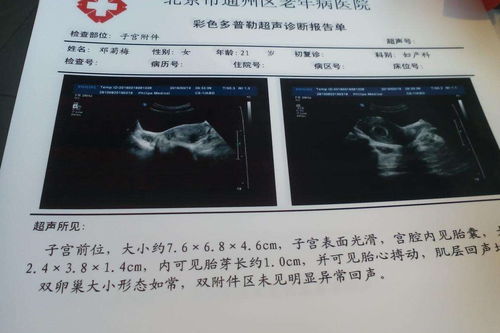 婚前,注意事項,時間,孕檢