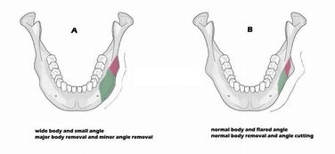 手術后,注意事項