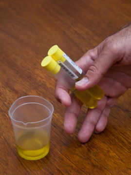 嬰幼兒尿標本采集方法及注意事項