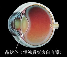 白內(nèi)障注意事項和飲食,術(shù)后白內(nèi)障注意事項,白內(nèi)障日常注意事項