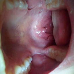 息肉,術(shù)后,嗓子,注意事項(xiàng)