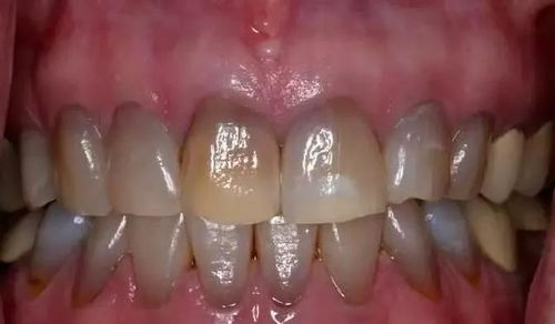 四環(huán)素牙注意事項