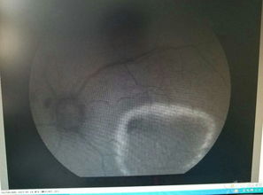 輸卵管造影做完后注意事項(xiàng),碘海醇造影后注意事項(xiàng),輸卵管造影后的注意事項(xiàng)