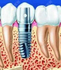 手根再接術(shù)后注意事項(xiàng)