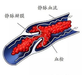 下肢靜脈血栓形成注意事項(xiàng),下肢深靜脈血栓形成注意事項(xiàng),深靜脈血栓形成的護(hù)理注意事項(xiàng)