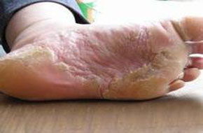 癬菌疹注意事項(xiàng)