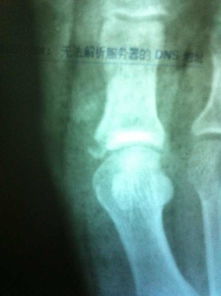 石膏拆了后的注意事項(xiàng),骨折拆石膏后注意事項(xiàng),石膏拆除后的護(hù)理注意事項(xiàng)