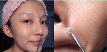 粉刺針清痘后注意事項,粉刺瘤切除后注意事項,針清閉口粉刺后注意事項