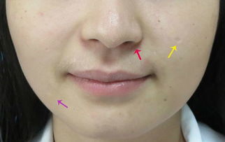 手術(shù)去黑痣前注意事項