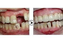 全鋯鑲牙注意事項