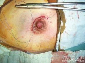 乳腺纖維瘤開刀后注意事項