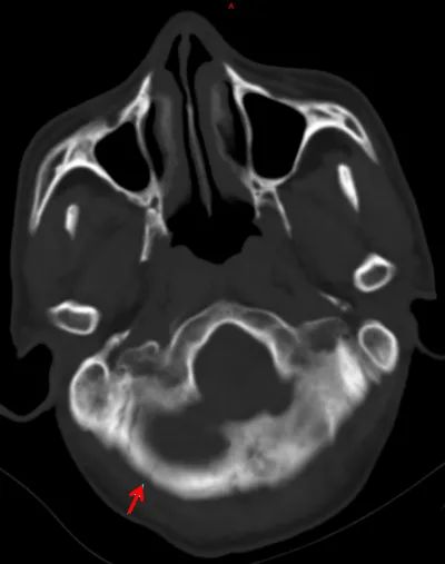 頭顱ct需要注意事項
