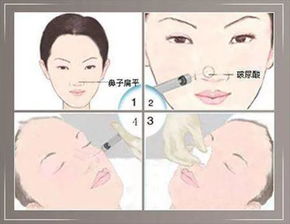 鼻子打完波尿酸注意事項(xiàng)