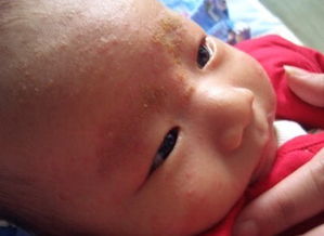 寶寶干性濕疹注意事項(xiàng)