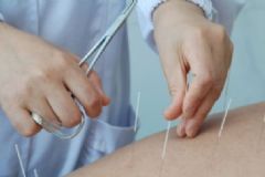 針灸出針的注意事項(xiàng)