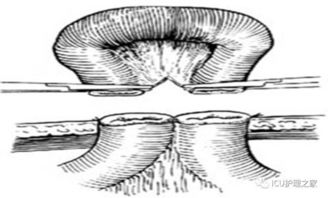 結(jié)腸灌洗術(shù)注意事項