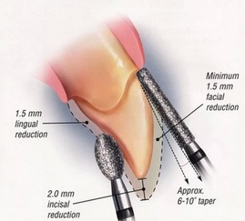 全瓷牙的注意事項,全瓷牙安裝后注意事項,全瓷牙戴牙后注意事項