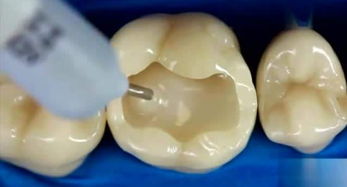 補(bǔ)牙后注意事項(xiàng)與禁忌癥,補(bǔ)牙上藥后注意事項(xiàng),補(bǔ)牙后的注意事項(xiàng)及飲食