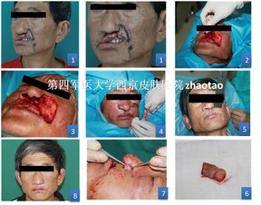 基底細(xì)胞癌術(shù)后應(yīng)注意事項(xiàng)