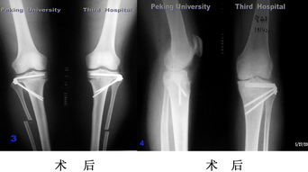 脛骨植骨后的注意事項(xiàng)