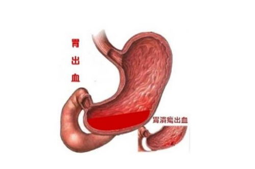 注意事項(xiàng),飲食,胃出血