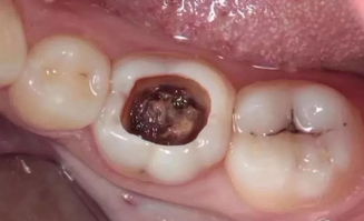 補牙,拔牙,注意事項