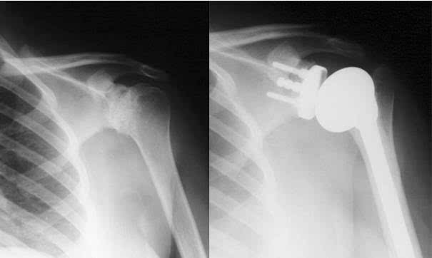 肩關(guān)節(jié)基礎(chǔ)知識